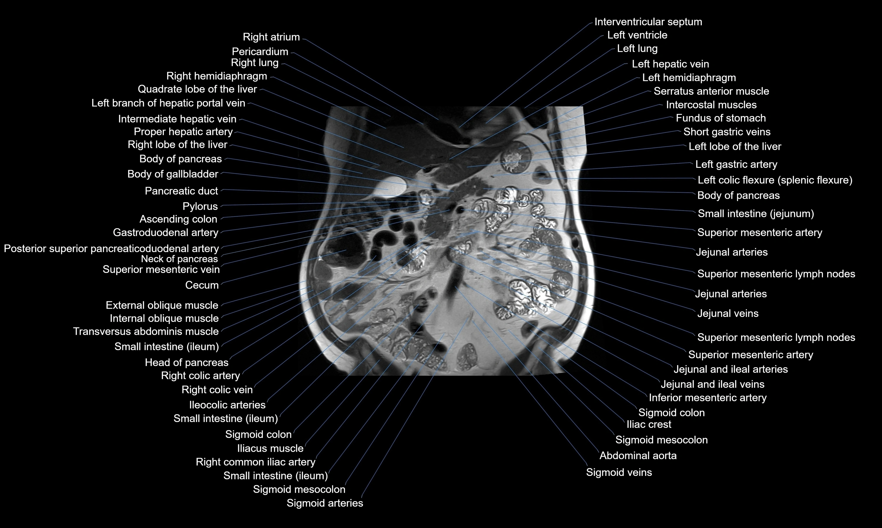 MRI Abdomen axial cross sectional anatomy radiology  image-img-00001-00025.webp